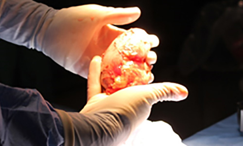 亚洲无码 Transplant Center image of doctor holding transplant piece